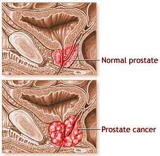 imagine cu cancerul prostatei